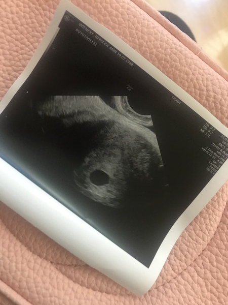 Gestational sack no yolk