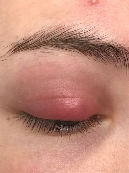 Dd swollen eyelid