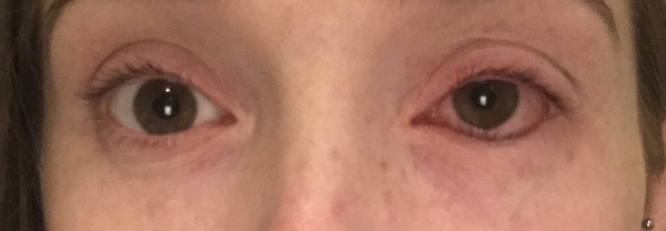 Hayfever this year. Worse than ever.