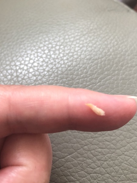 Sound the KLAXON - I grew my own tonsil stone!