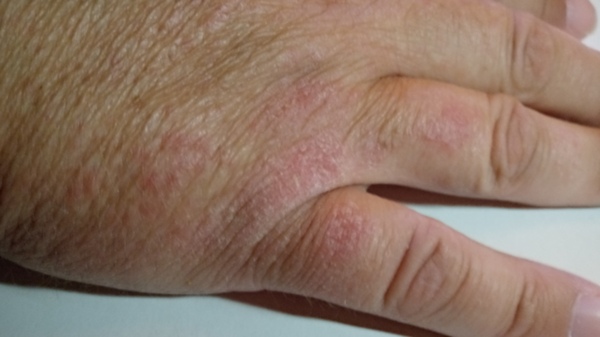 The skin on my hands