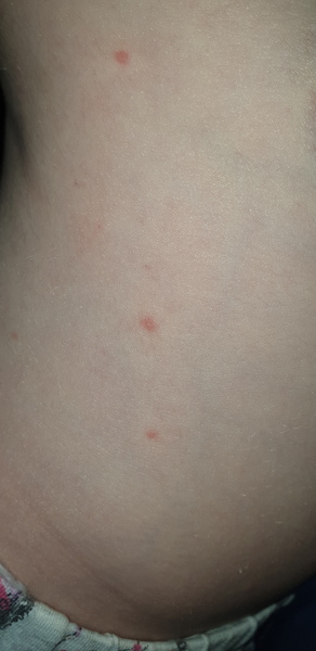 Can anyone help me identify if this is chicken pox?