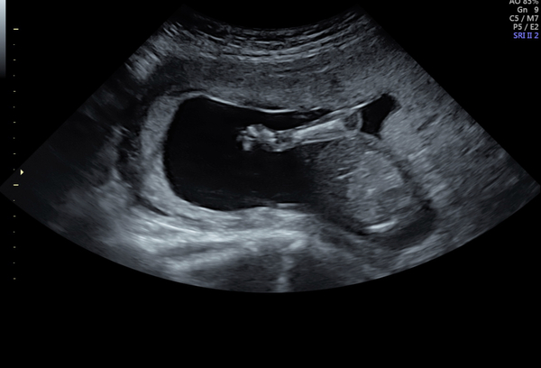 Low lying placenta