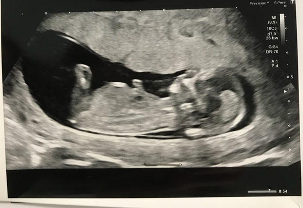 What’s your guess please?! Girl or boy?