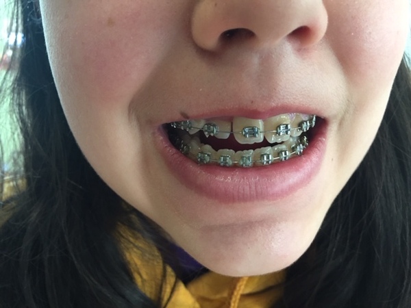 Othodontists advice please - Bracket has come off DDs tooth...