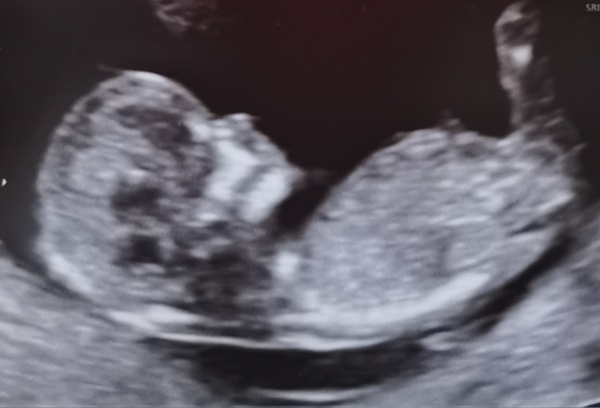 Boy or Girl?