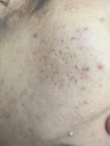 Awful skin (pigmentation and pick marks on cheeks for years) PICS included