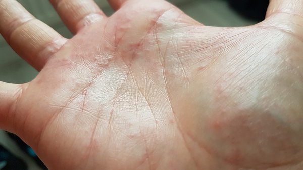 Rash only affecting one hand