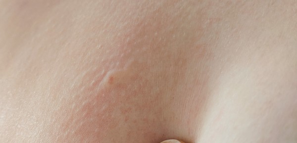 Help -insect bite