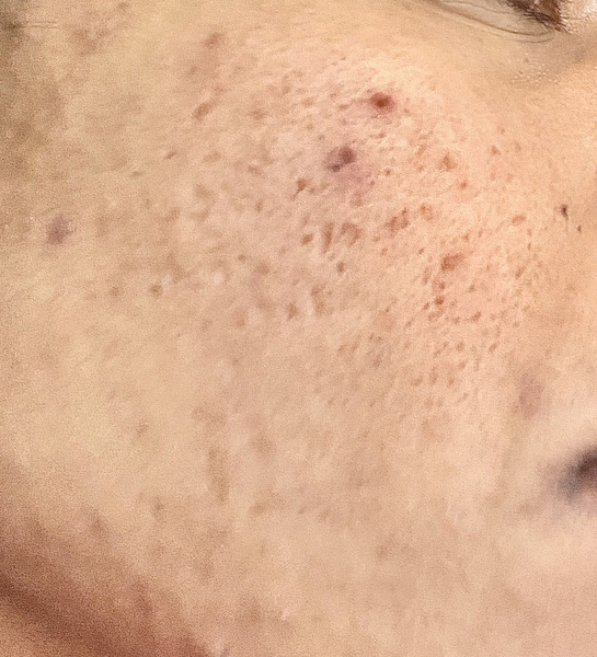 Awful skin (pigmentation and pick marks on cheeks for years) PICS included