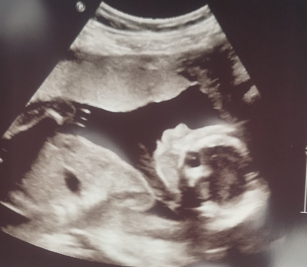 Pregnant after loss and dreaming of rainbows - 3