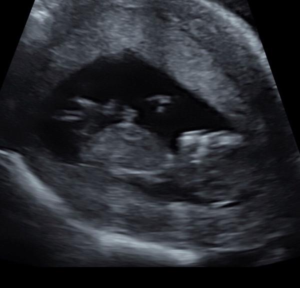 Boy or girl?