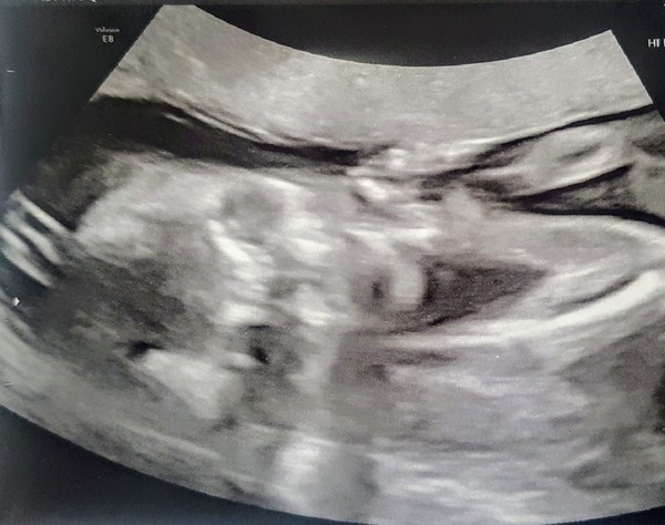 Anyone else due August 2020?