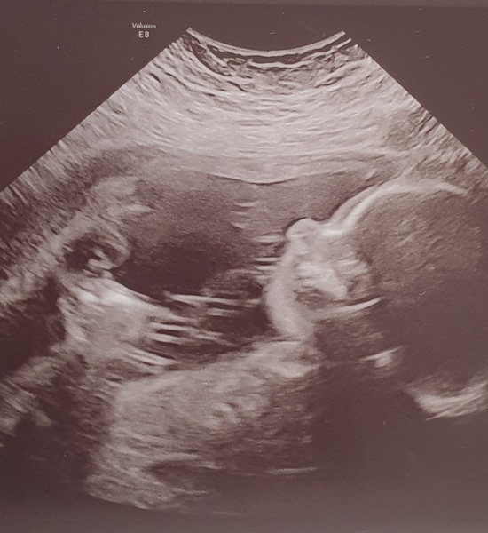 20 week scan gender guess (for fun!)