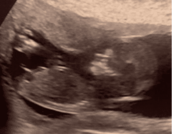 12w5d boy or girl guesses