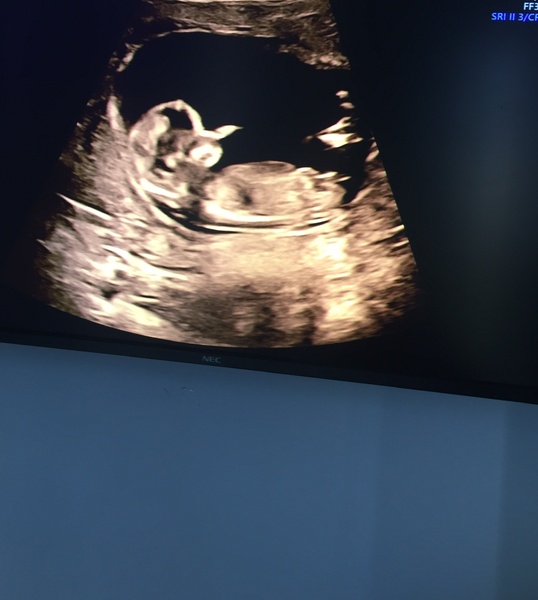 12 week scan - girl or boy?!