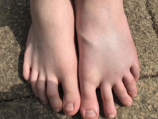 Possible broken toe/foot