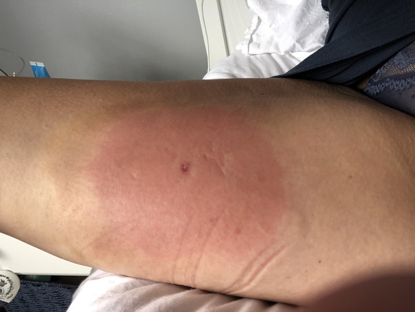 Insect bite!