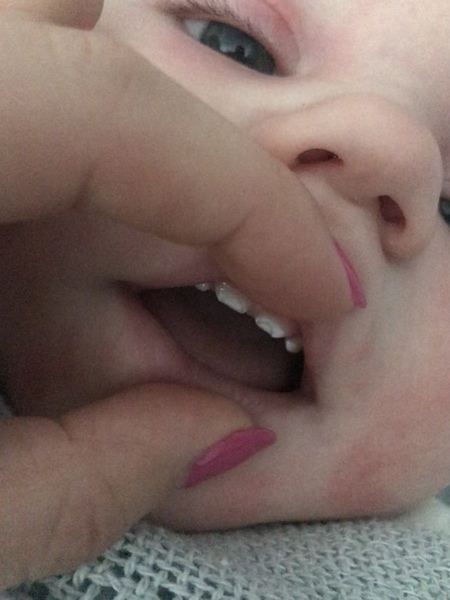 Baby teeth grinding