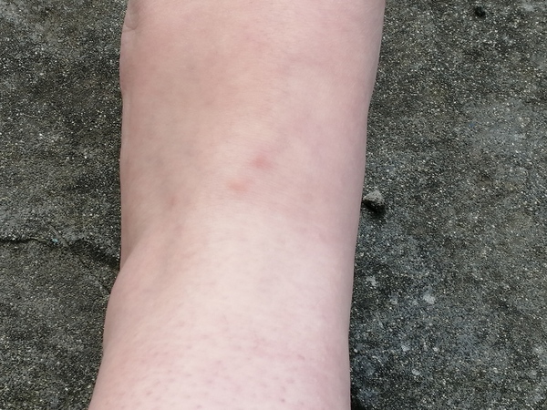 Red itchy lumps 38weeks pregnant