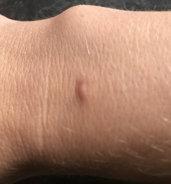 What is this on my wrist? Molluscum?