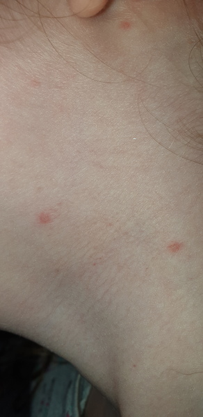 Can anyone help me identify if this is chicken pox?