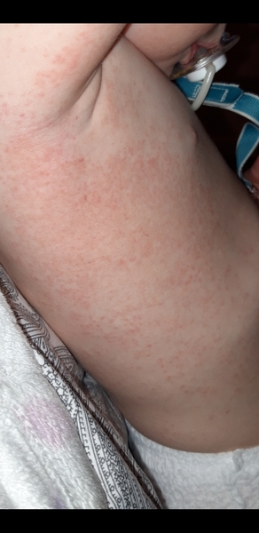 To ask on here what this rash is on my 1yo?