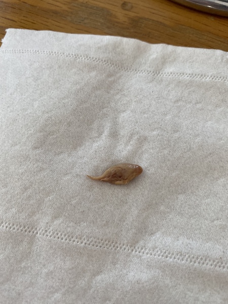 HELP - Any midwifes about?? Loss of tissue at 16 weeks :(