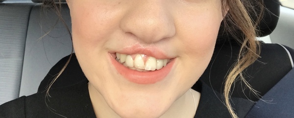 7 year olds top teeth still haven't regrown help!!