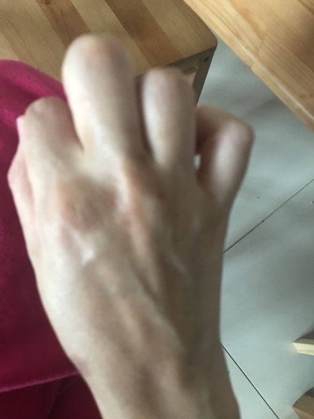 Petrified! Health anxiety skin lymphoma!