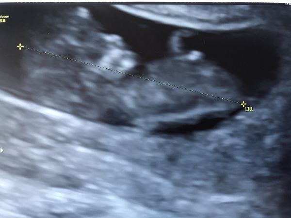 Anyone got a scan today?