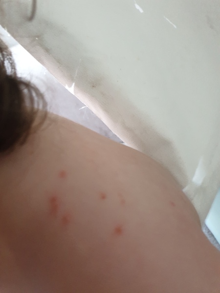Is this chickenpox?
