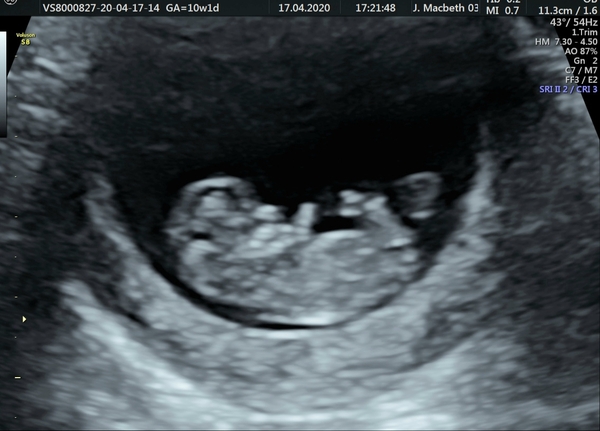 Constant anxiety due to previous miscarriage