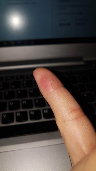 What's up with my fingertip? Possible blood clot? With pic