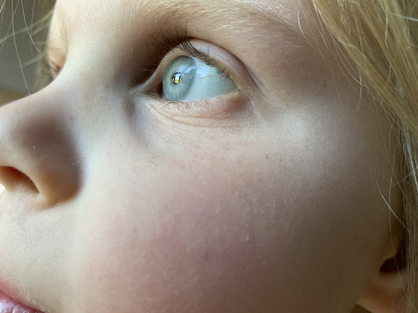 Little red marks around eye?
