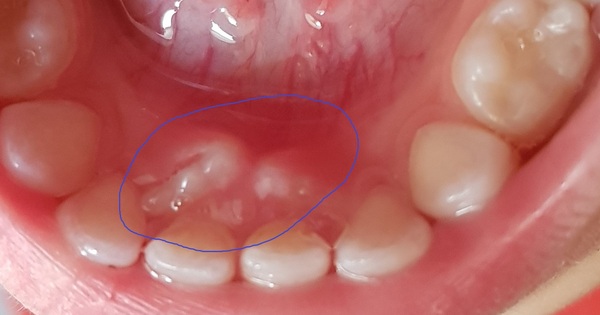 URGENT: Dental professional's opinion needed; pic attached