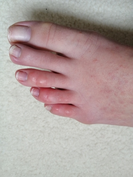 Has anyone else got ‘COVID toes’