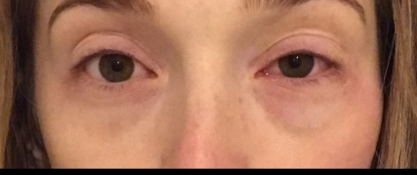 Hayfever this year. Worse than ever.