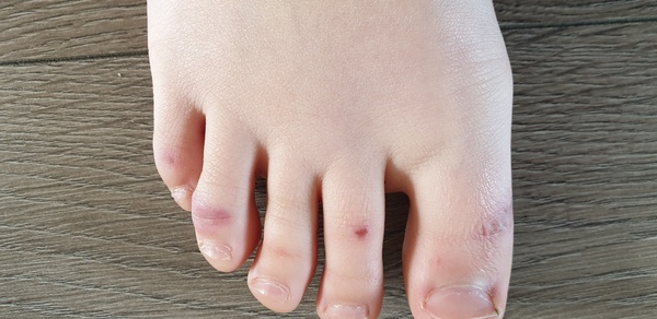 Has anyone else got ‘COVID toes’