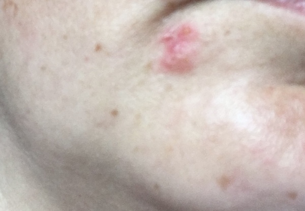 Would you say this was a coldsore? Or impetigo?