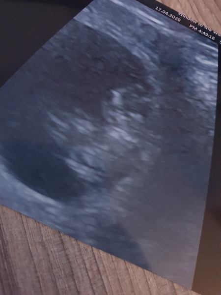 Constant anxiety due to previous miscarriage