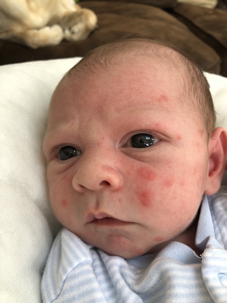 Spots on 3 week olds face