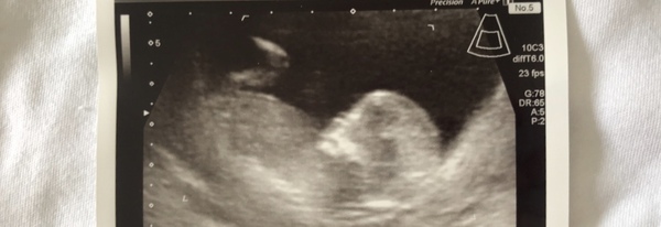 12 week scan gender guesses