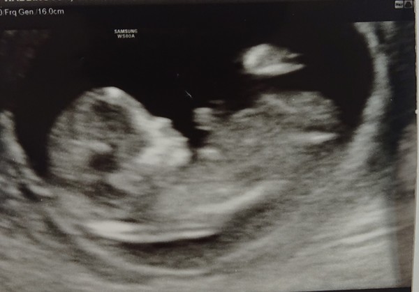 12 week scan. Boy or girl?