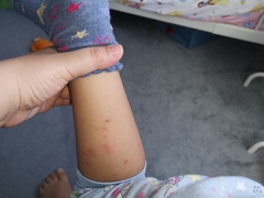 Bug bites
