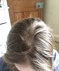 Hair loss / extremely thin