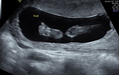 Low lying placenta