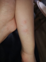Bug bites