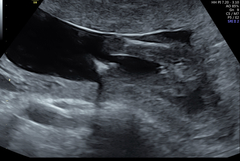 Low lying placenta