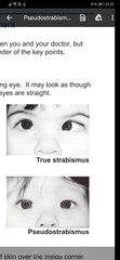 Baby 16 weeks (4 months in 8 days) and still cross eyed?